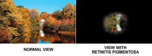 Two images side by side, left image is of a lake with waterfall surrounded by autumnal trees. The right side of the image has all but a small proportion of the image blacked out, just showing he waterfall part along with the caption "view for someone with Retinitus Pigmentosa